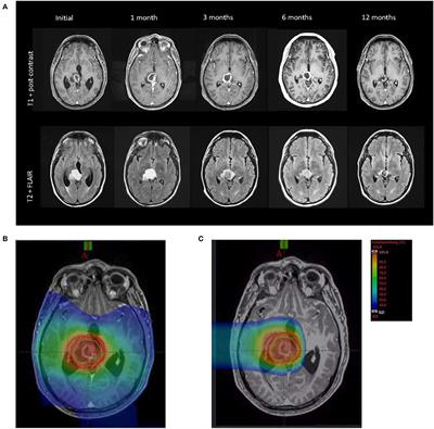 Case Report of Complete Radiological Response of a Thalamic Glioblastoma After Treatment With Proton Therapy Followed by Temozolomide and Tumor-Treating Fields